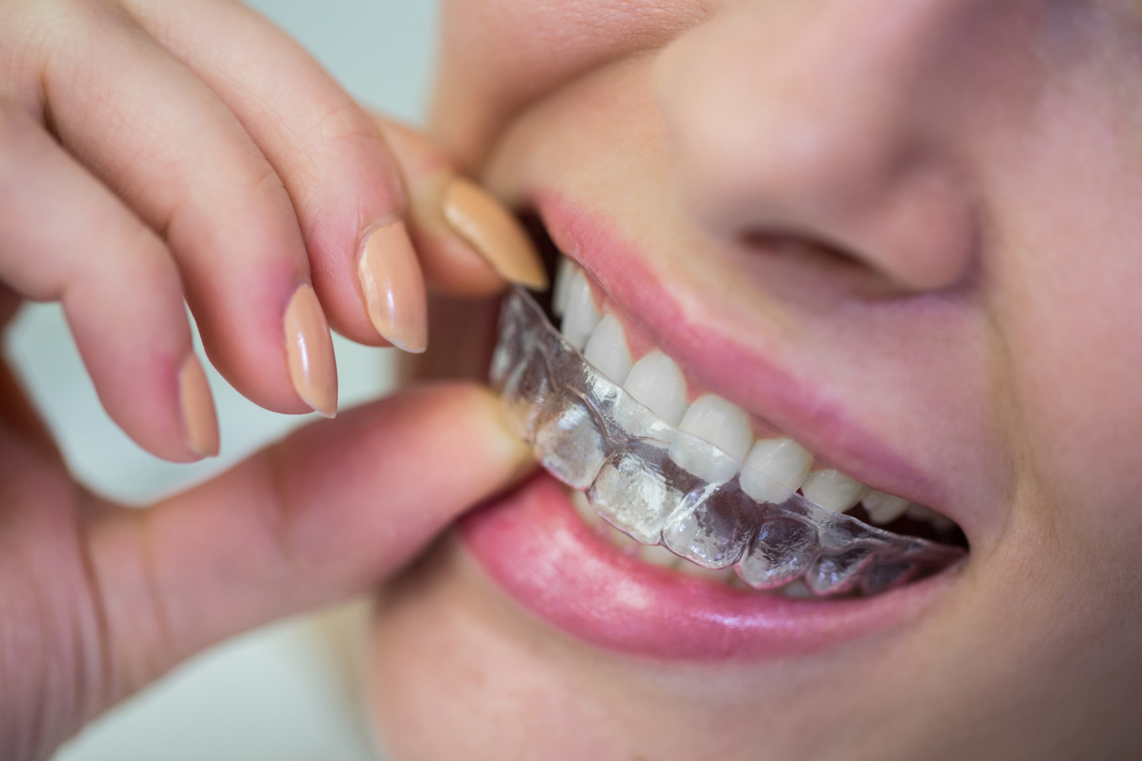 Woman wearing invisible orthodontic aligner